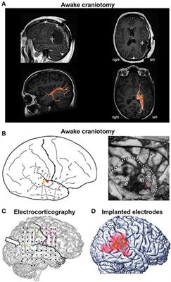 Commentary: Out-of-Body Experience during Awake Craniotomy